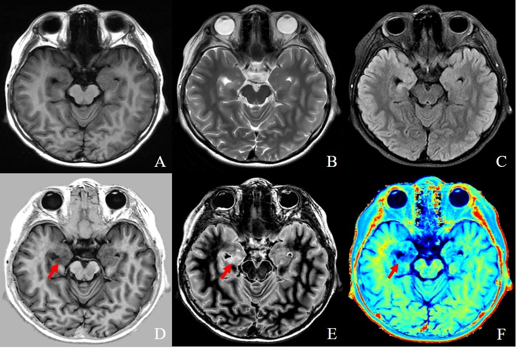 Comparison Of Conventionalmri A ~ C And Synthetic Mri D~f Conventional T1flair A T2wi B 2581